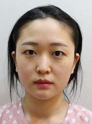 一口气在韩国艾恩做了双眼皮+隆鼻综合+面部脂肪填充+瘦脸