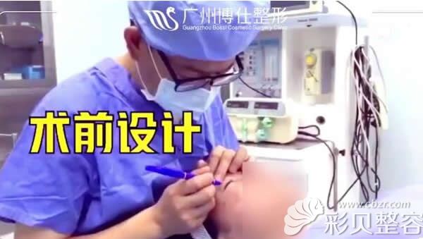 广州博仕李帅敏主任术前精细设计双眼皮手术方案