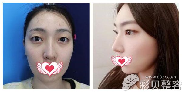 在韩国纯真做鼻修复前后对比照