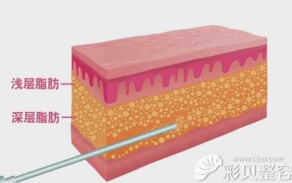 传统吸脂方式只能抽取深层脂肪