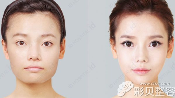 韩国ID李知赫High-L颧骨缩小和下颌角、下巴整形效果图