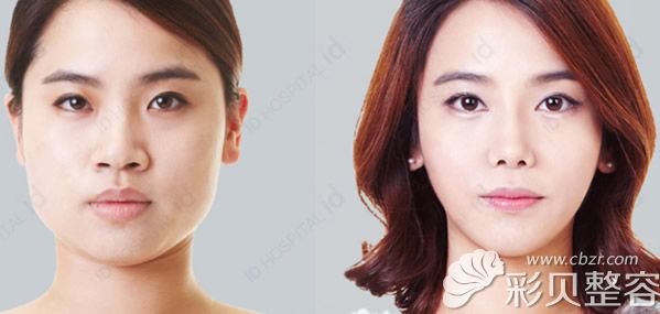 id医院李知赫凸嘴矫正、下颌角截骨和下巴整形案例