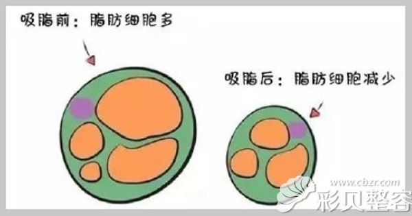 吸脂前后脂肪细胞对比
