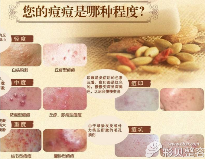 关于后背长痘痘的原因,趁早正确治疗别让小问题成大
