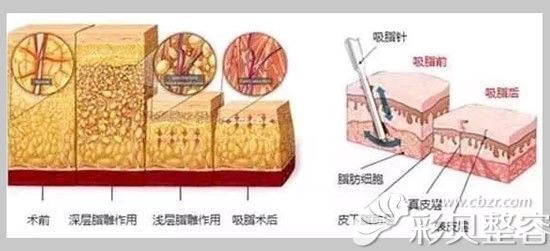 吸脂原理图