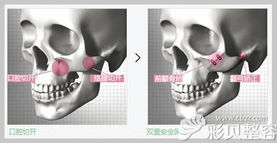 原辰颧骨整形采用口腔切口，双重安全固定