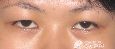 韩国艾恩金承俊院长解答为什么肿眼泡割完双眼皮还是肿?