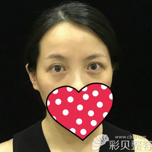 重庆郑荃丽格祛眼袋高清记录毛钰婷给我做纳米无痕祛眼袋