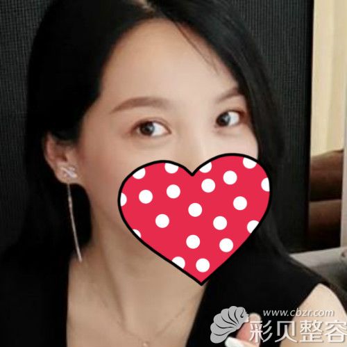重庆郑荃丽格祛眼袋高清记录毛钰婷给我做纳米无痕祛眼袋