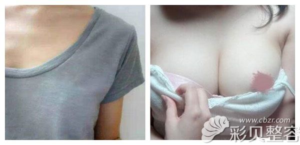 曼托假体隆胸200cc术前术后<span style=