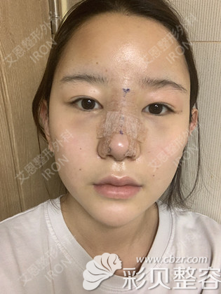 韩国艾恩硅胶隆鼻术后3天