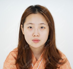 驼峰鼻的我经过韩国艾恩鼻综合的改善变化简直不要太大