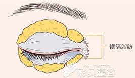 脂肪性肿泡眼示意图