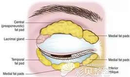 脂肪型+肌肉型肿泡眼示意图