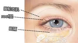 眼皮松弛型肿眼泡