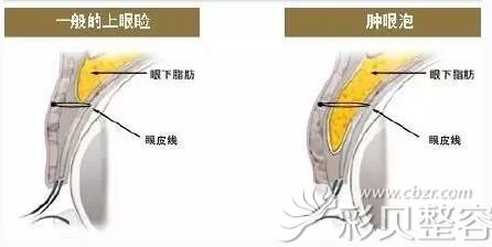正常眼睛和肿泡眼图片对比