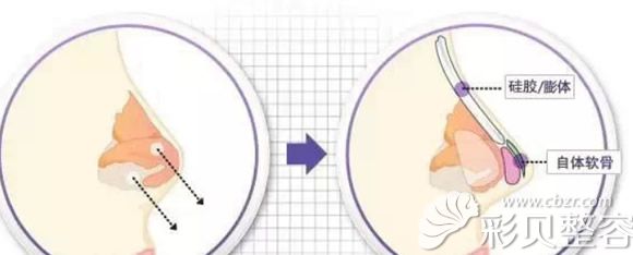 耳软骨多用于垫鼻尖