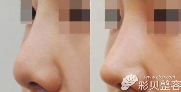 耳软骨隆鼻6年前后对比图