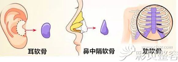 垫鼻尖的材料有耳软骨肋软骨和鼻中隔软骨