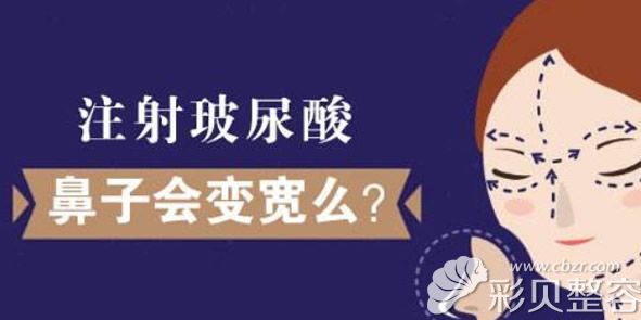 玻尿酸隆鼻后鼻子会变宽吗 玻尿酸隆鼻后鼻子会变宽吗