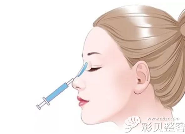 玻尿酸隆鼻需要打几次 玻尿酸隆鼻需要打几次