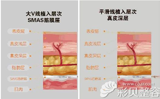 大V线和小V线植入的层次 大V线和小V线植入的层次