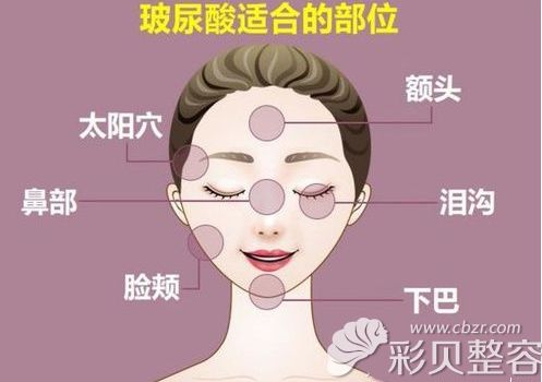 面部适合注射玻尿酸的部位 面部适合注射玻尿酸的部位