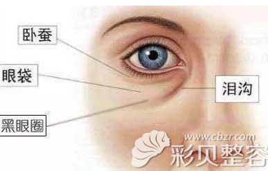 泪沟和眼袋的区别示意图 泪沟和眼袋的区别示意图