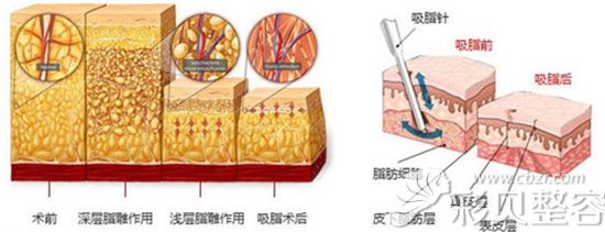 吸脂原理图