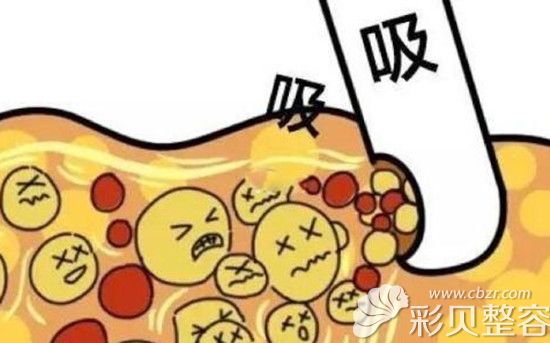 吸脂卡通图