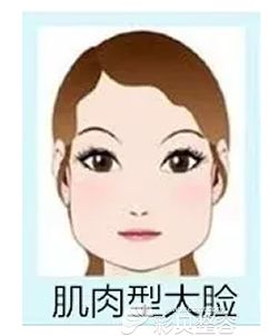 咬肌肥大需要注射针剂