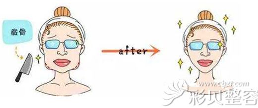 下颌角截骨前后效果对比