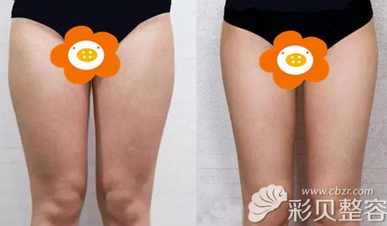 吸脂前后示意图