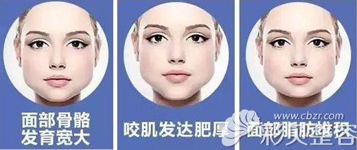 下颌角宽大的原因