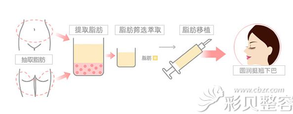 脂肪填充下巴流程