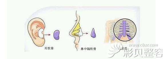 自体软骨隆鼻材料