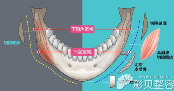 下颌角切除的部位