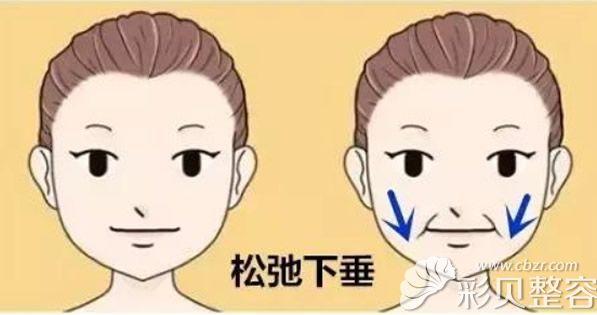 磨骨四个月脸下垂了