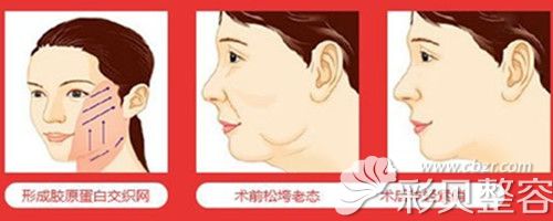 做面部埋线提升效果图