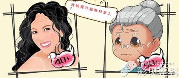 强生鱼骨线能保持多久