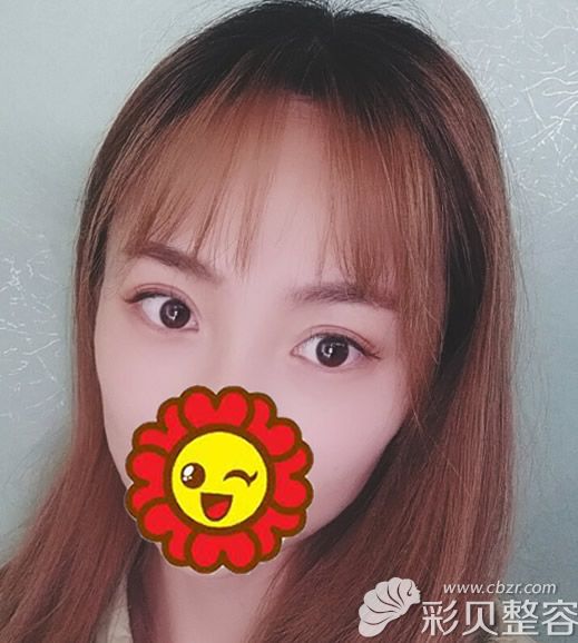 全切双眼皮6毫米效果图:虽然宽度变窄了但眼睛并没有成内双
