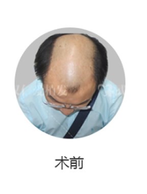 我是男生,遗传性脱发,在武汉仁爱植发三个月了,看看效果图!