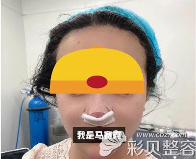 洛阳莱尔美刘战辉隆鼻案例：舒铂超肋鼻术后第3天效果图片