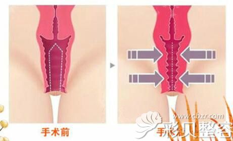 阴道松弛做缩阴手术能提高爱爱时的敏感度 阴道松弛做缩阴手术能提高爱爱时的敏感度