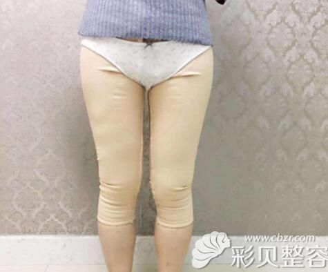 大腿吸脂穿束身裤的样子 大腿吸脂穿束身裤的样子