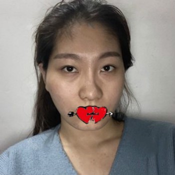 30岁,在杭州美天美做埋线提升脸部,埋线前后对比差别好大呀