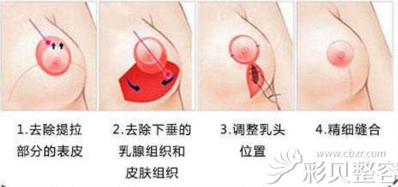 棒棒糖法乳房缩小上提术手术步骤 棒棒糖法乳房缩小上提术手术步骤