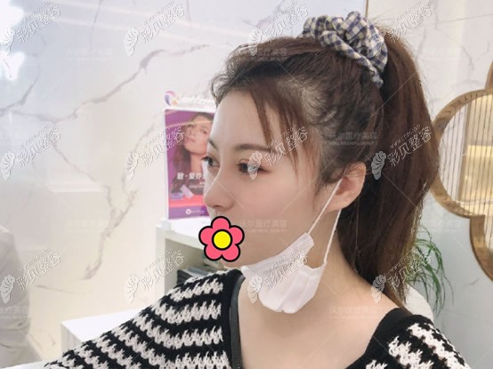 我在北京沃尔做歪鼻矫正三个月效果图