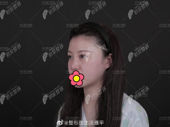 我在北京沃尔第六次修复鼻子前