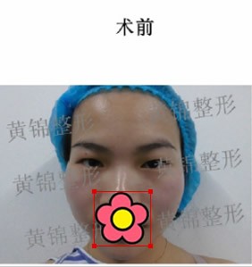 宁波整形外科医院黄锦医生,给我做全脸脂肪填充1年5个月了!